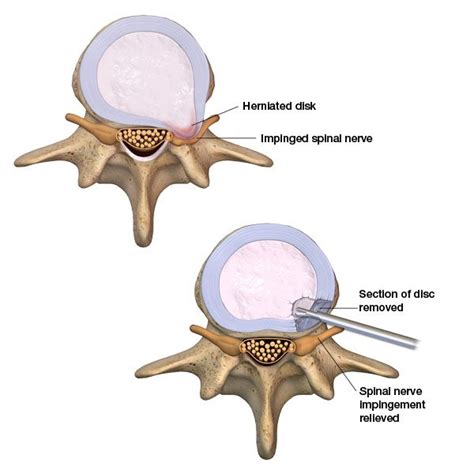 Keyhole Disectomy Centre For Orthopaedics