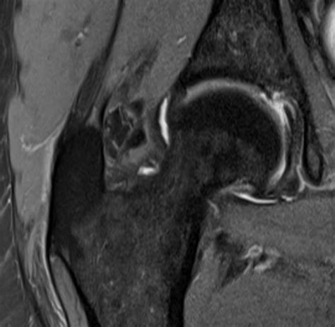 Abductor Tendon Tears The Bone School