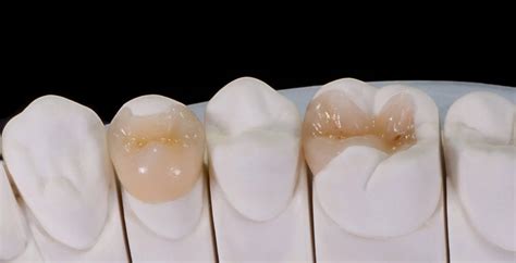 Inlays And Onlays Dental Fillings In Turkey Cost And Types