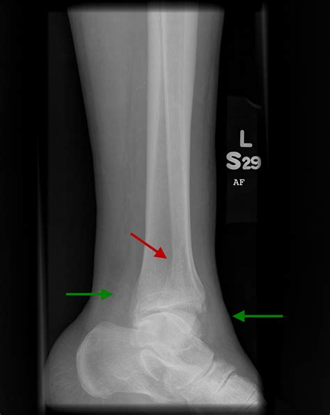 Distal Fibula Fracture