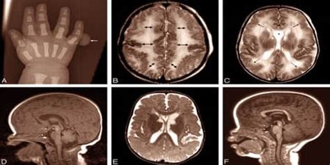 Megalencephaly - Assignment Point