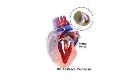 Mitral Valve Prolapse Storymd