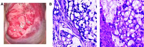 Primary Signet Ring Cell Carcinoma Of The Uterine Cervix In The Biopsy