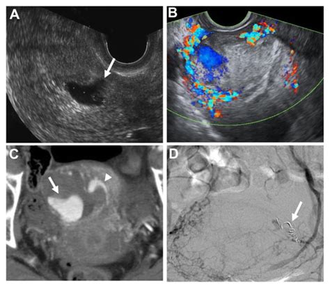 Findings In Initial Cesarean Scar Pregnancy A Transvaginal