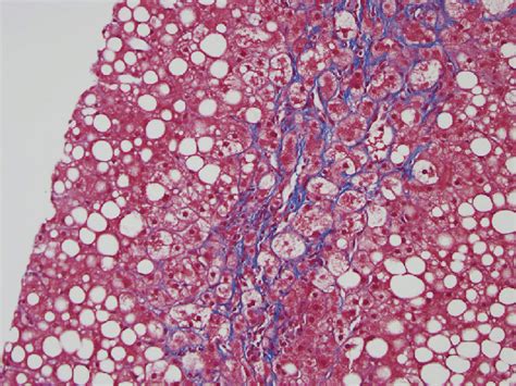 Masson Trichrome Stain Shows Perivenular Pericellular Chicken Wire