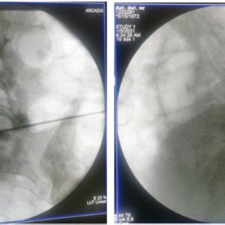 Contrast agent injection after final working zone was confirmed ...