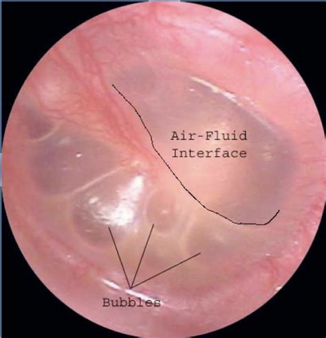 Tympanic Membrane With Effusion