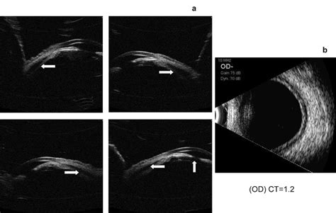 Ultrasound Biomicroscopy A Right Eye Showing Ciliochoroidal