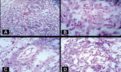 Figure From Endodermal Sinus Tumor Of Vagina In Infants Semantic Scholar