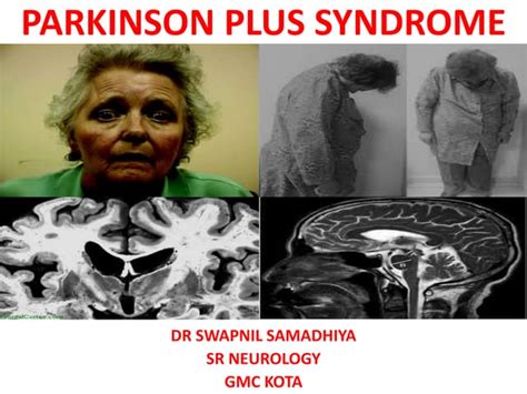 Parkinson Plus Ppt