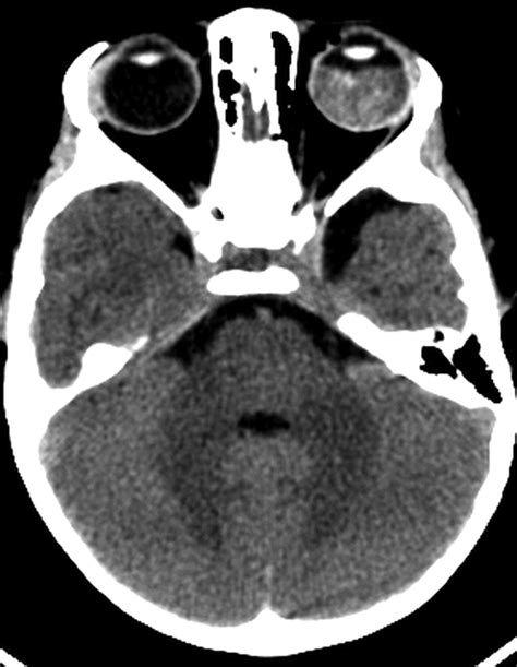 Trilateral Retinoblastoma Radiographics