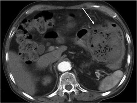 Abdominal Contrast Enhanced Computed Tomography Ct Findings An Download Scientific Diagram