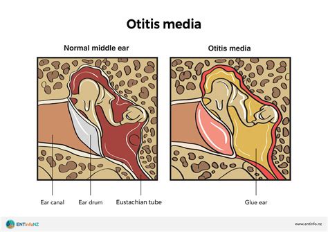 Otitis Externa With Effusion