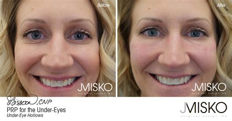 Prp For The Under Eyes Jmisko