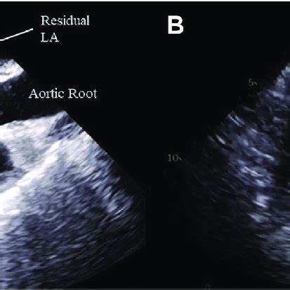 Two Dimensional TEE Midesophageal Aortic Valve Long Axis View Before