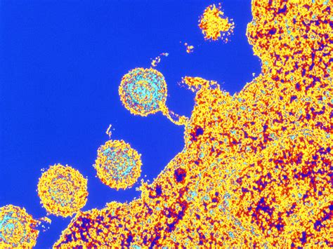 Herpes Viruses And Alzheimer's: A Possible Link : Shots - Health News : NPR