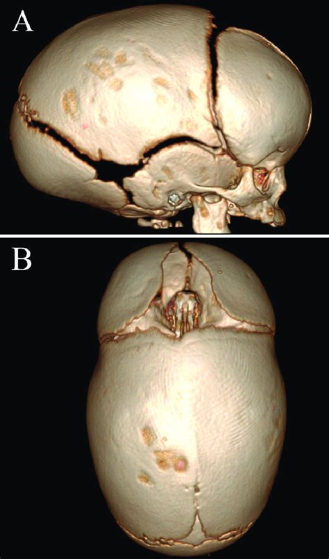 Three Dimensional D Ct Reconstructions Detailing Scaphocephaly A