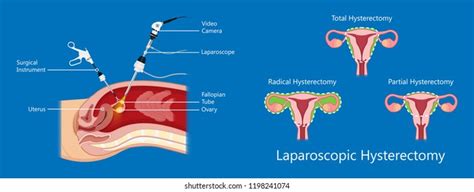 Laparoscopic Hysterectomy Medical Surgical Treat Cervix Stock Vector