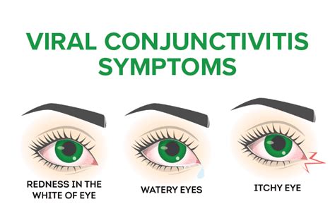 Signs and Symptoms of Pink Eye (Conjunctivitis)