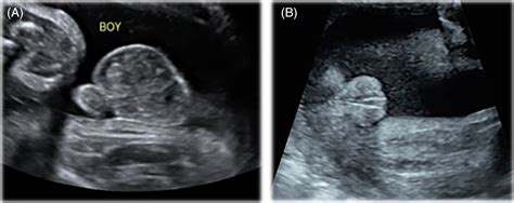 Discordant Fetal Sex On NIPT And Ultrasound Smet 2020 Prenatal