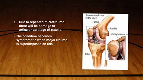 Chondromalacia Patella Desktop G8n93pspptx