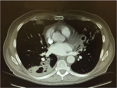 Pulmonary Vein CT Scan