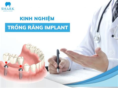 Kinh Nghi M Tr Ng R Ng Implant Quan Tr Ng B N N N Bi T