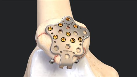 Arthrex SuturePlate II Patella Fracture Repair System