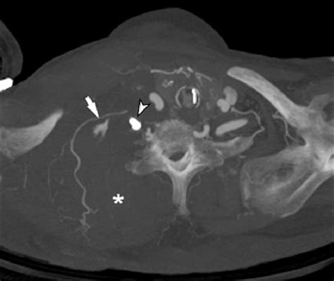 Axial Image Of Arterial Phase Contrast Enhanced Multislice Computed