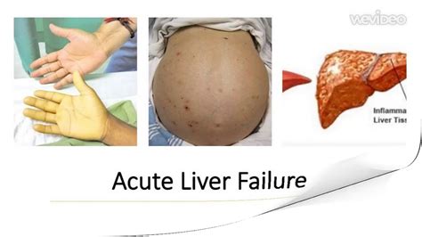 Liver Failure Pathophysiology