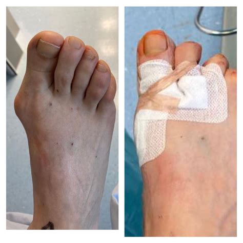 Op Tag In W Rgl Minimalinvasive Hallux Valgus Op