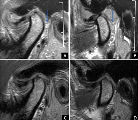 Chondromatosis Of The Temporomandibular Joint As A Cause Of Reflex