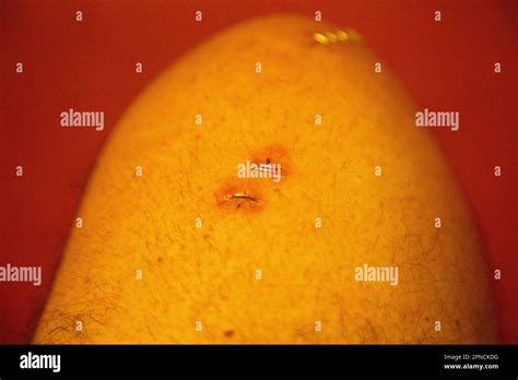 Surgical Staple Closing Incision After Unicompartmental Arthroplasty