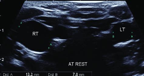 Internal Jugular Vein Ultrasound