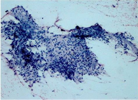 Photomicrograph Of Aspiration Cytology Smear Of A Case Of Alveolar Download Scientific Diagram