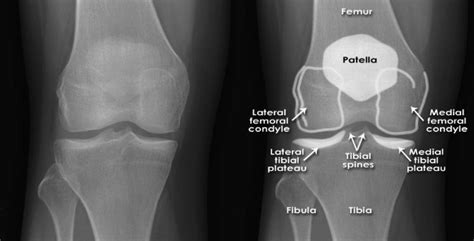 KNEE FRACTURES Midwest Orthopaedics