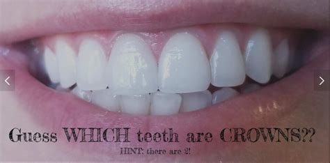 Beautiful Dental Crowns SHOULD Look Like Natural Teeth! - Ivory Dental ...