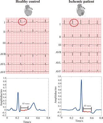 Frontiers Reliable Detection Of Myocardial Ischemia Using Machine