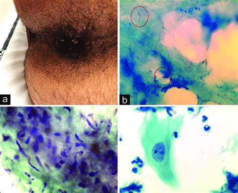 A Perianal Warts Condyloma Acuminate B Acid Fast Bacilli On Zn Download Scientific