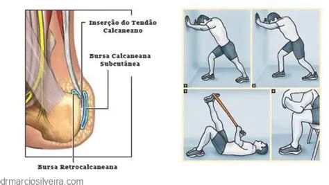 Tratamento Da Tendinite Do Calc Neo