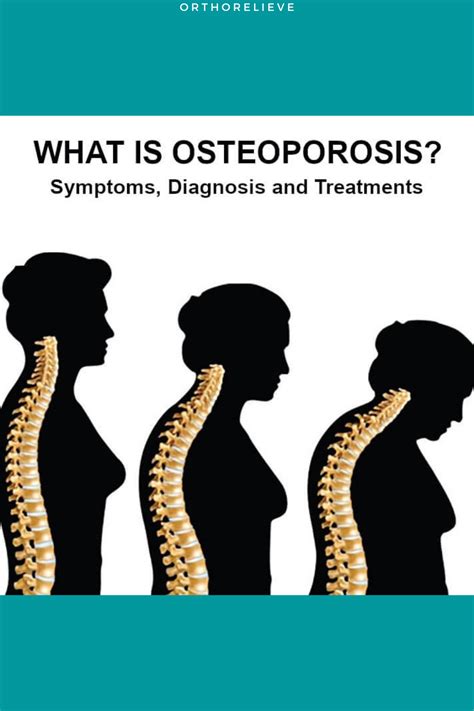 What Is Osteoporosis Artofit