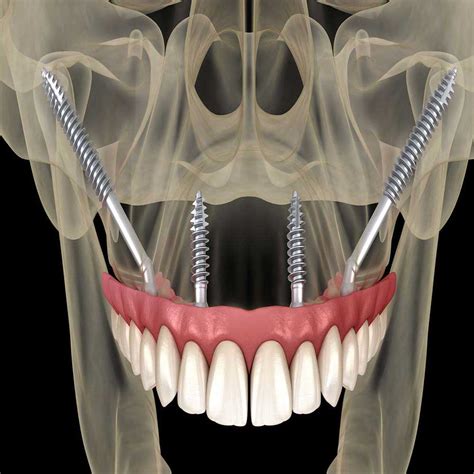 Zygomatic Dental Implants Are The Ultimate Solution For Severe Bone