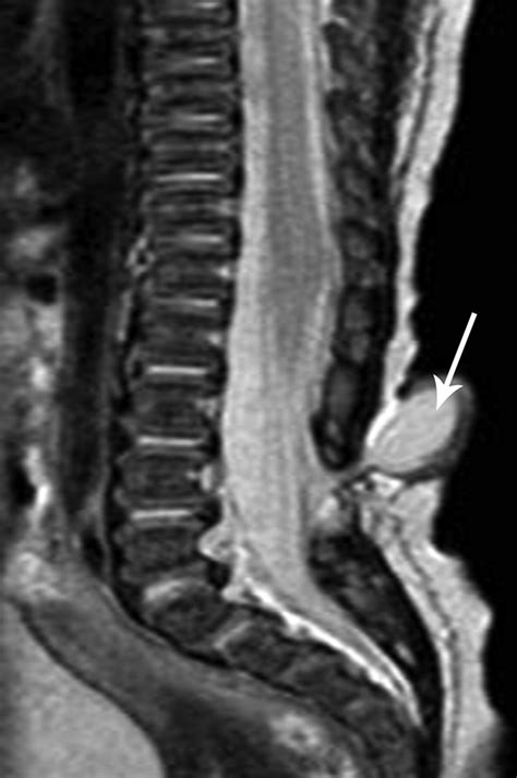 Spina Bifida Mri