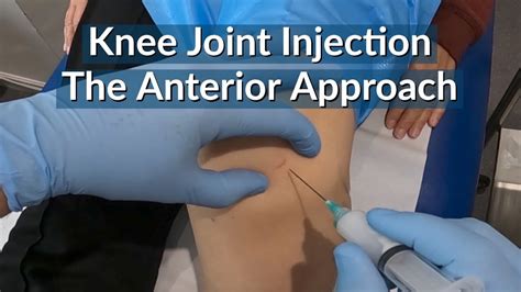 Knee Joint Injection The Anterior Approach Eyes Of The Knee Hot Sex