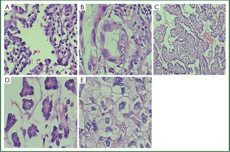 Figure 1 From Histological Subtypes Of Solitary Pulmonary Nodules Of