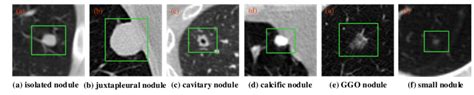 Example Image Of A Heterogeneous Lung Nodule In Ct Image Note That E