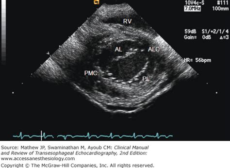 Epicardial Echocardiography and Epiaortic Ultrasonography | Anesthesia Key