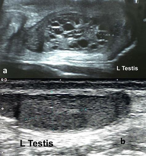 Spontaneous Regression Of Suspected Cystic Dysplasia Of The Rete Testis