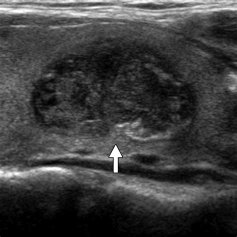 Performance of Preoperative Sonographic Staging of Papillary Thyroid ...