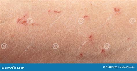 Wound On Human Skin Macro Stock Image Image Of Bleed 314465285